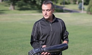 Ben Shortreed had to have his left hand amputated last year after it was severely injured when a mortar exploded as he was lighting fireworks with friends outside of his town of Verona home. One of his two prostheses responds to sensors on his forearm to allow the hand to open