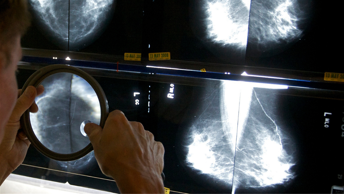 New updates to US Food and Drug Administration mammography regulations require mammography facilities to notify patients about the density of their breasts.